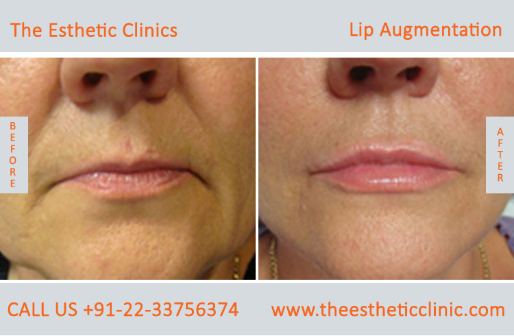 Lip Augmentation, Lip Enlargement, Lip Implant Surgery before after photos in mumbai india (2)